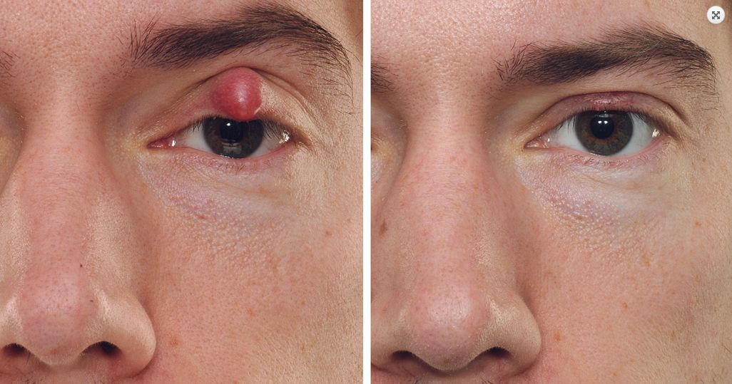 benign eyelid tumors 1