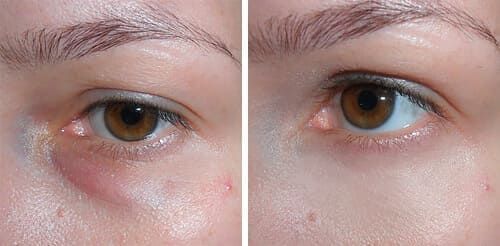 benign eyelid tumors2