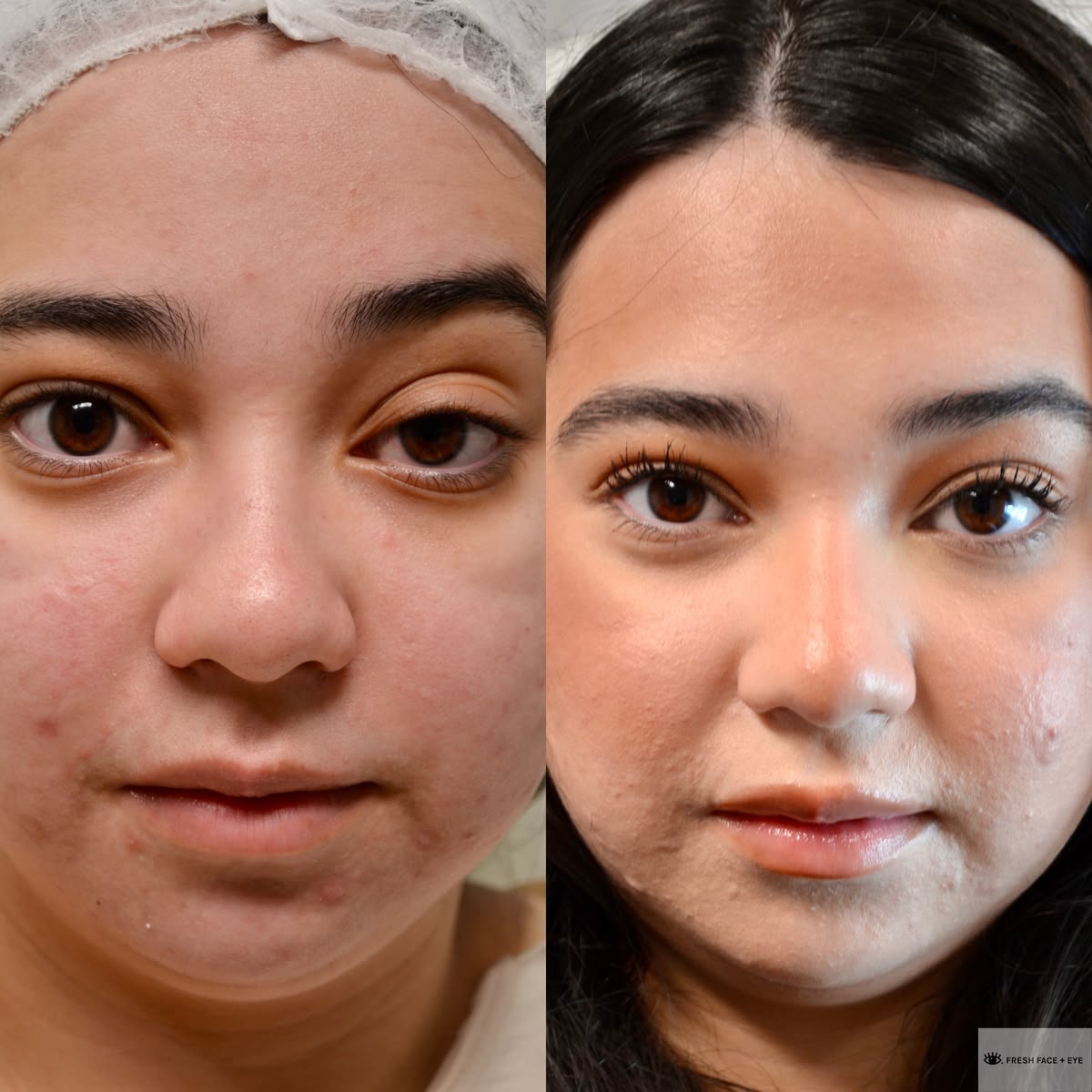 ptosis