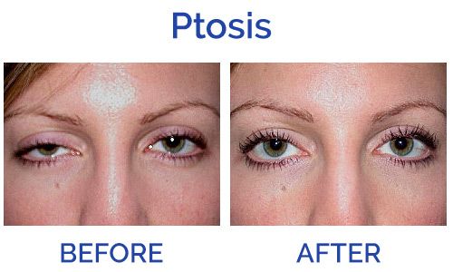 ptosis2