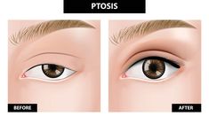 ptosis3